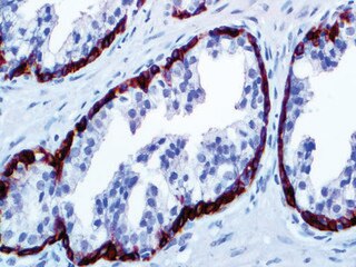 IHC of CK34BE12 on an FFPE Prostate Tissue